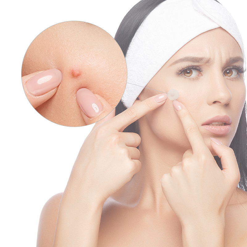 رقعة حب الشباب