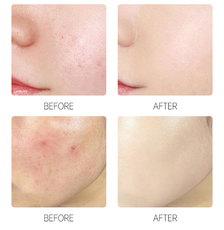 رقعة حب الشباب